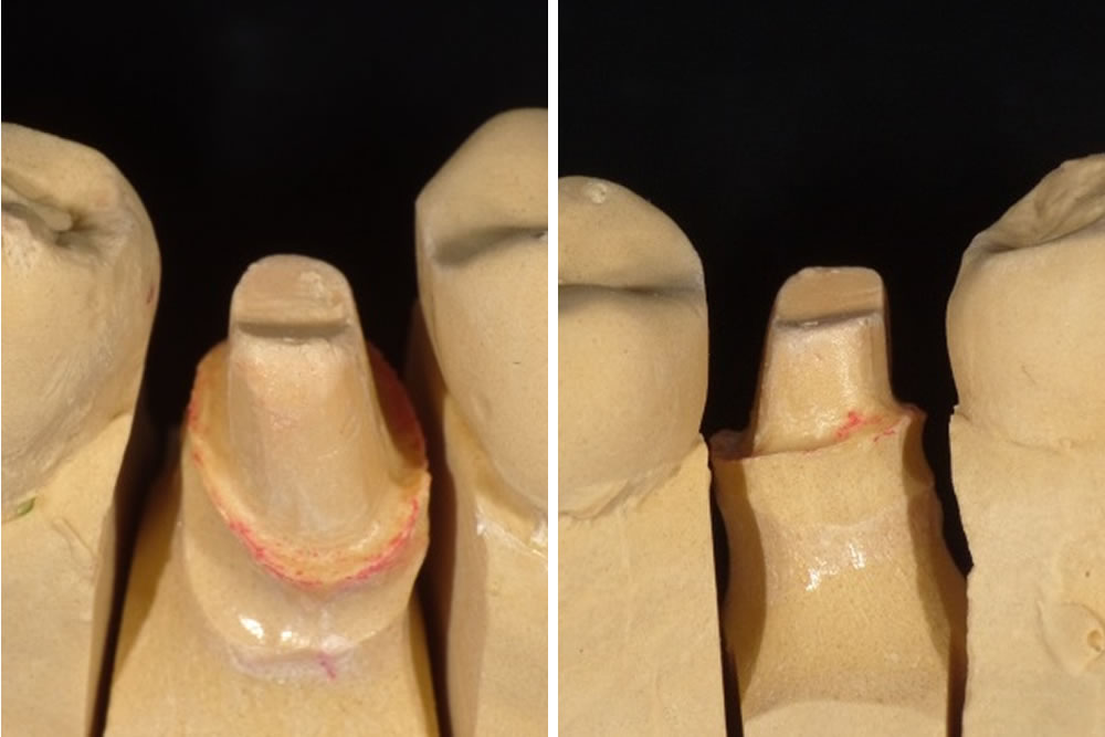 土台の歯の形成